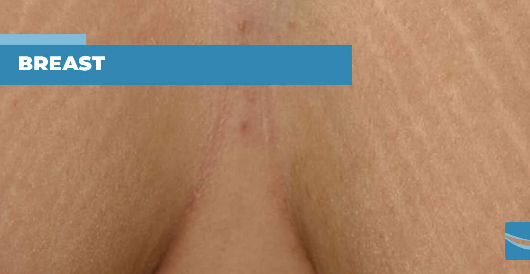 Stretch marks on breasts: what to do