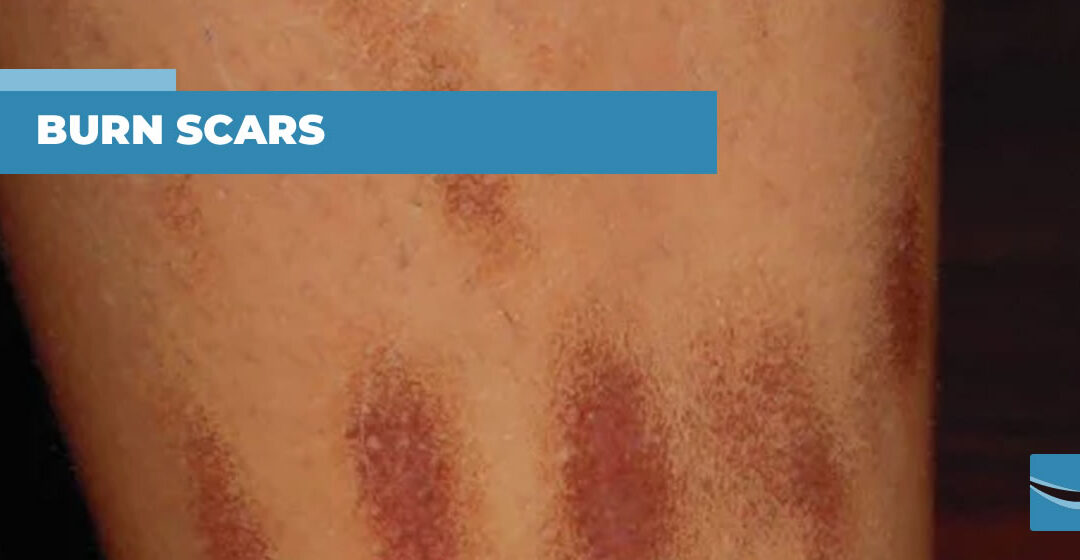 Burn scars caused by pulsed light: what to do?