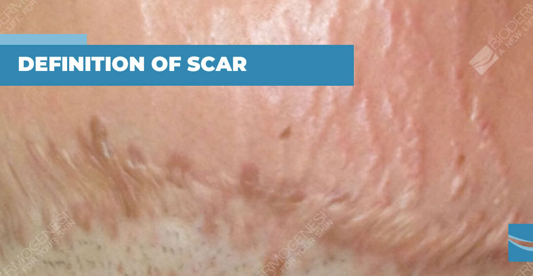 Description and definition of scar