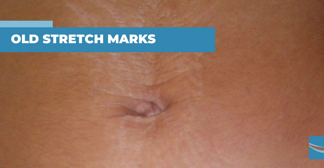 How to Treat Old, White and Pearlescent Stretch Marks