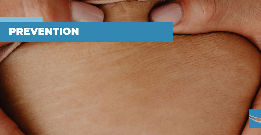 Can you prevent stretch marks?