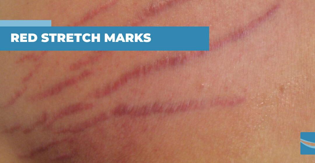 Why should we treat red stretch marks right away?
