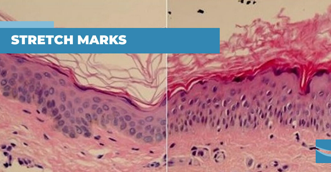 What Are Stretch Marks?