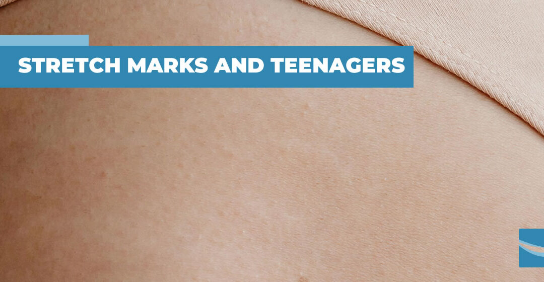 Stretch Marks and Teenage Boys